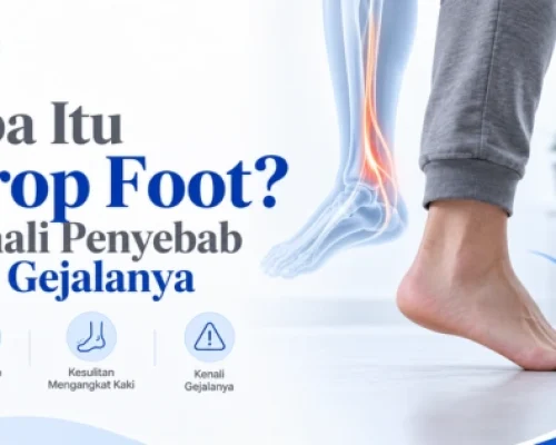 apa itu foot drop